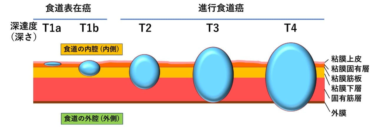 食道がんグラフ