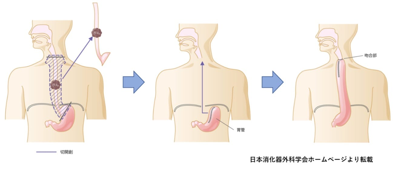 食道がんグラフ