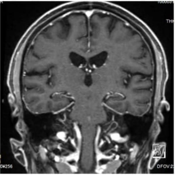 頭部造影MRI