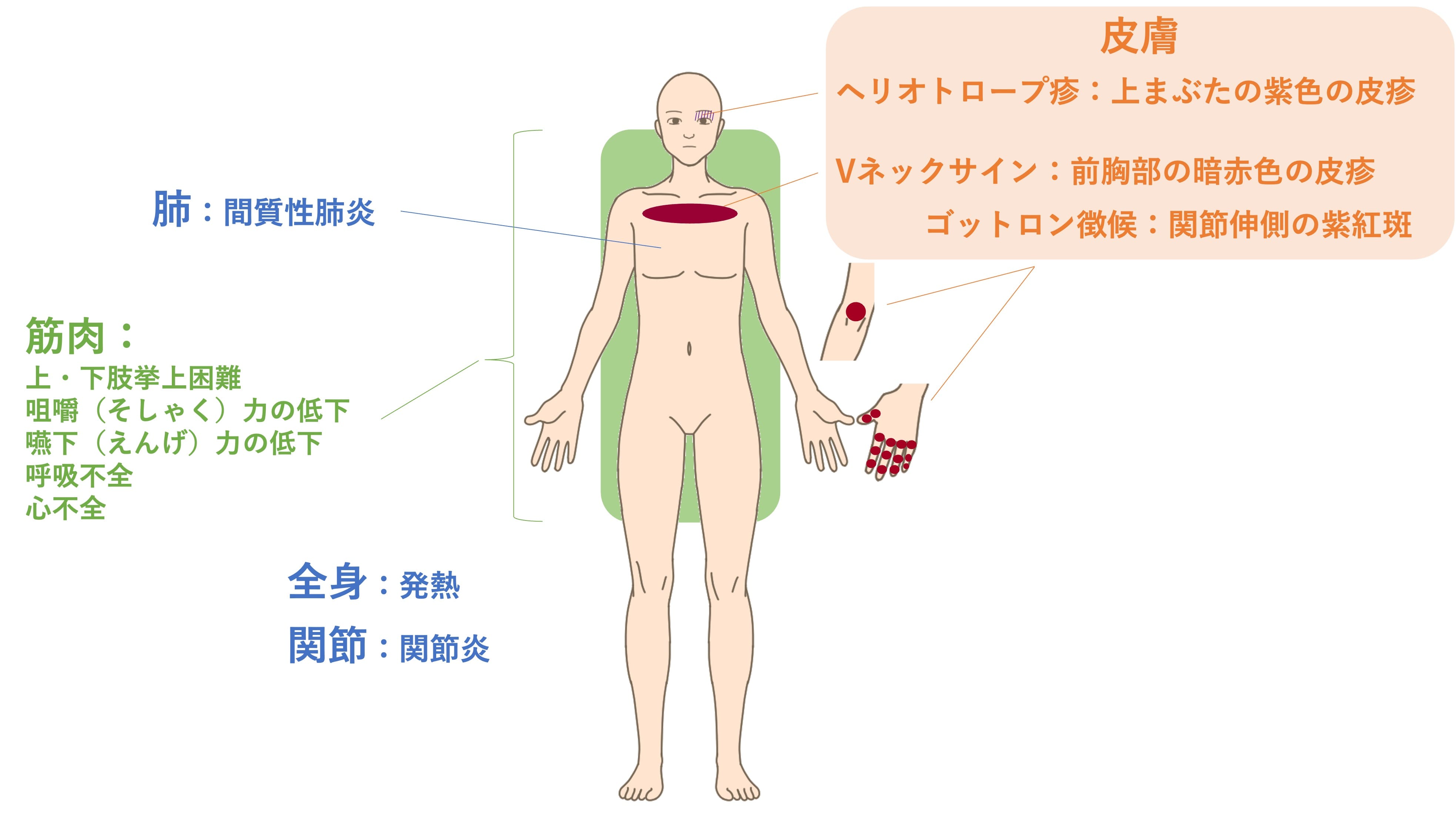 皮膚筋炎・多発性筋炎