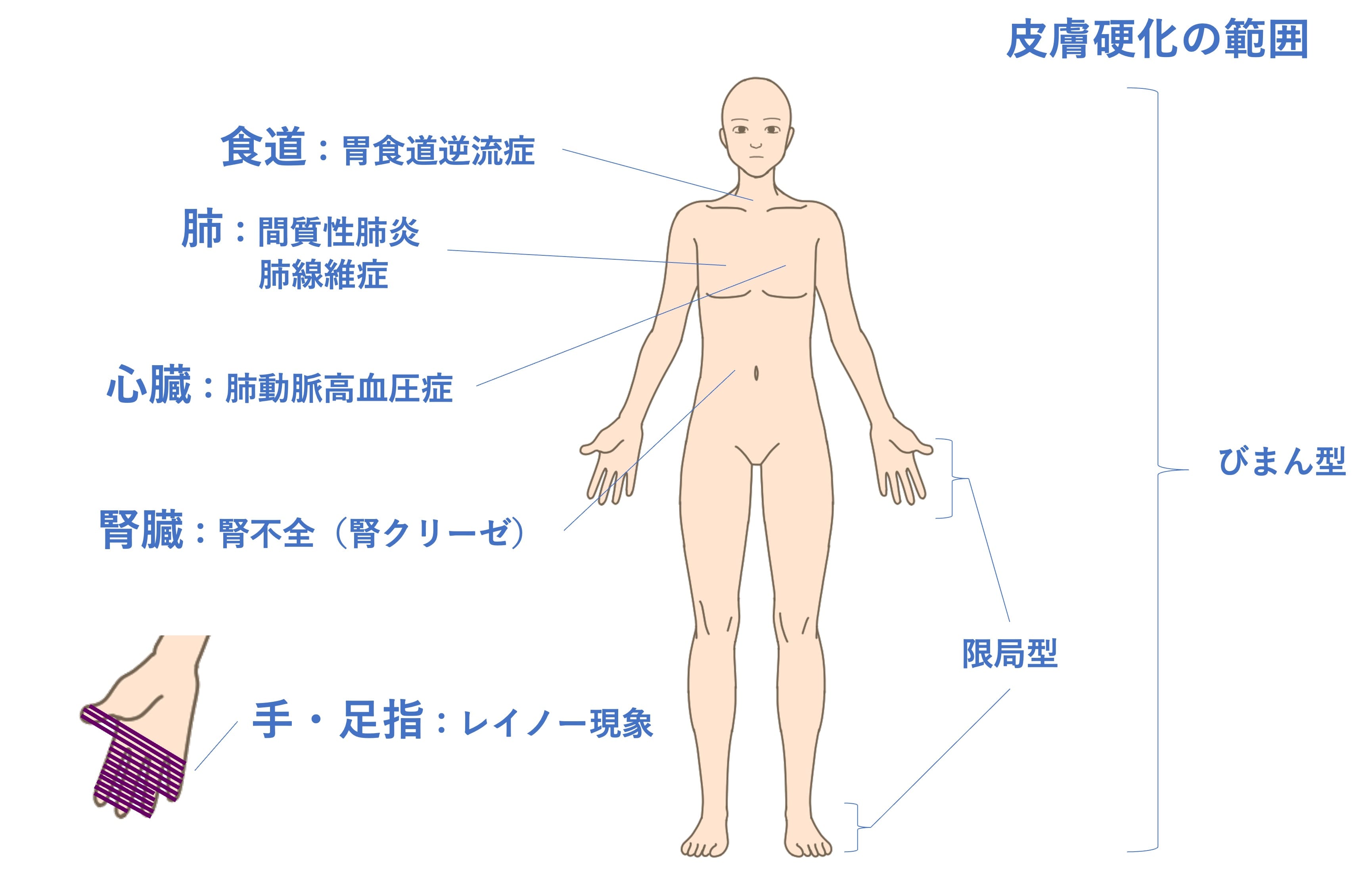 全身性強皮症