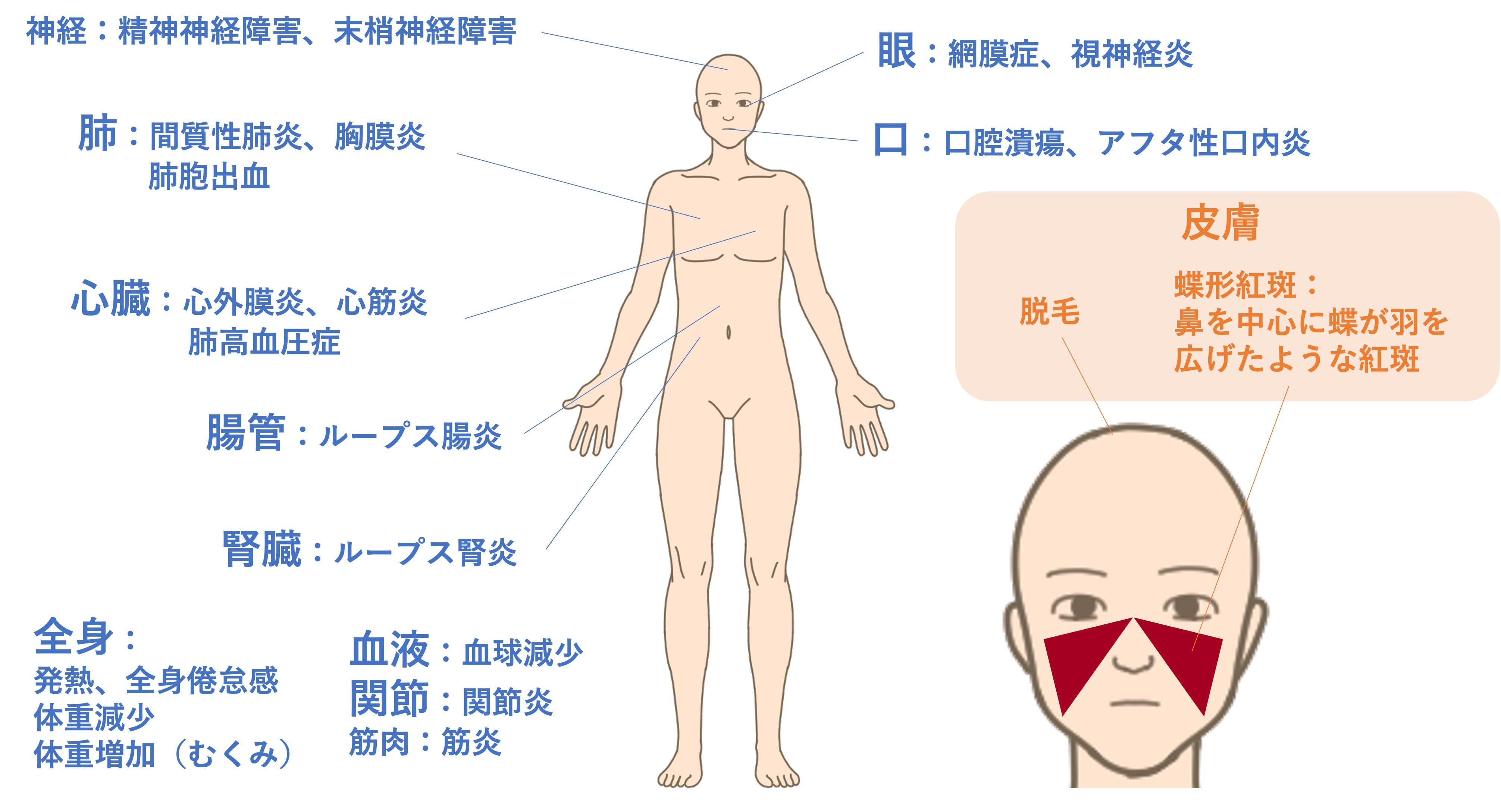 全身性エリテマトーデス